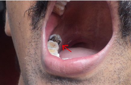 Під коронкою зуб гниє симптоми і способи лікування