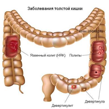 Simptome de colon Simptome și metode de tratament