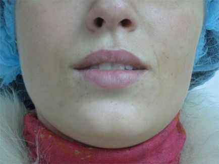 Наслідки збільшення губ гіалуроновою кислотою набряк після процедури, рекомендації по догляду та