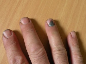 Причини, чому синіють нігті на руках, сині нігті на пальцях ніг