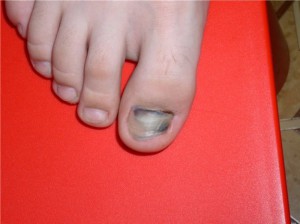 Motivele pentru care unghiile sunt unghiile albastre, albastre pe degetele de la picioare