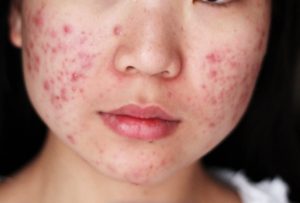 Akne ivás után a valódi oka és kezelési eljárások (acne) Akne ivás után a valódi oka, és hogyan kell kezelni
