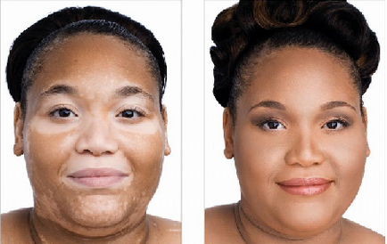 Manifestări de vitiligo și tratamentul cubanez al melageninei plus