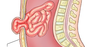 Hernia ombilicală la copii, cauze, simptome și tratament