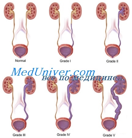 Vezicii urinare-reflux ureter la copii - cauze, diagnostic