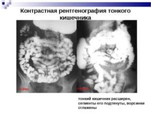 Рак тонкого кишечника - ознаки, симптоми, прояв