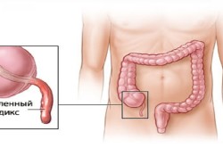 Răspândirea durerii în partea de jos a stomacului provoacă