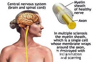 Scleroza multiplă - simptome, tratament, cauze