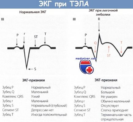 Рентгенографія грудної клітини при ТЕЛА