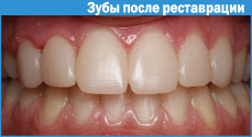 Restaurarea dinților cu fotopolimeri