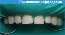Restaurarea dinților cu fotopolimeri