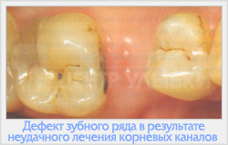 Restoration fotopolimert fogak