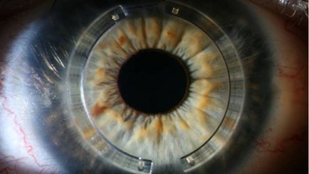 Inele corneene (segmente intrastromale) - implantare în keratoconus