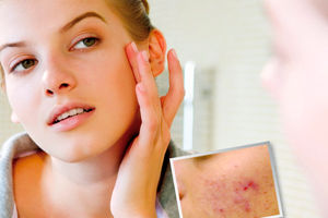 Peelingul salicilic este cel mai eficient tratament pentru pielea cu probleme