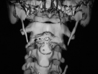 Sindromul Shilo-sublingual cauzează simptome și tratament