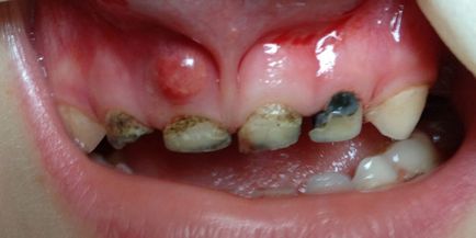 Tünetek és jelek különböző típusú fogszuvasodás gyermekek és felnőttek, a betegség diagnózisa fotó