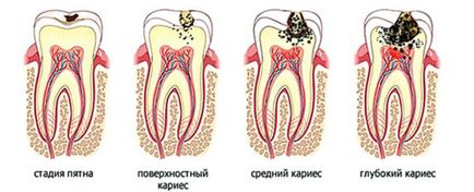 Tünetek és jelek különböző típusú fogszuvasodás gyermekek és felnőttek, a betegség diagnózisa fotó