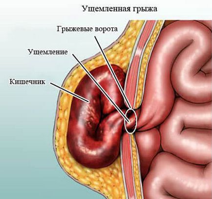 Simptomele herniei abdominale strangulate, diagnostic, operație