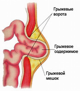 Simptomele herniei abdominale strangulate, diagnostic, operație