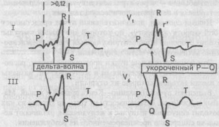 Sindromul excitarii ventriculare premature