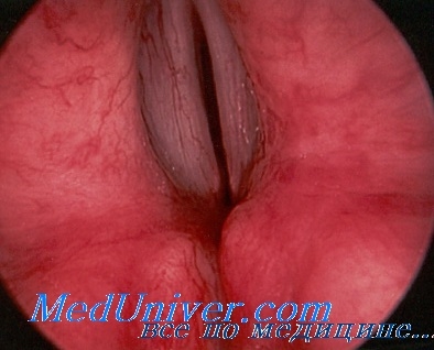 Scleromul tractului respirator superior