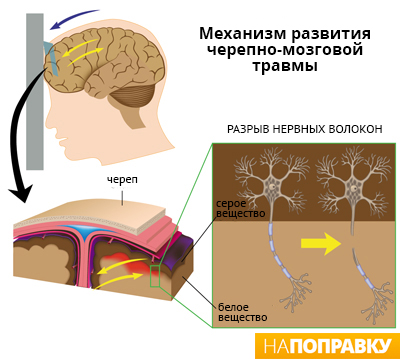 Струс мозку ознаки, симптоми і лікування - напоправку