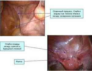 Simptomele inflamației intestinale și tratamentul cu medicamentele folclorice - bolile intestinale -if () - endif -