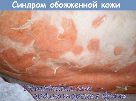 Sindromul stafilococ al pielii (arsurilor) ars - diagnostic, tratament