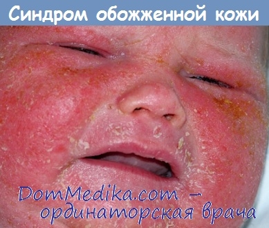 Sindromul stafilococ al pielii (arsurilor) ars - diagnostic, tratament