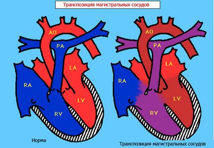 Транспониране от най-големите съдове - причини, симптоми, лечение, korregirovat пълен, в плода,