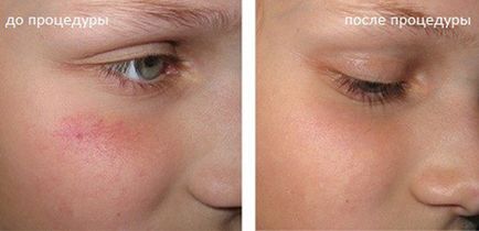 Видалення купероза на обличчі лазером і іншими методами