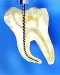 Видалення нерва зуба наслідки процедури