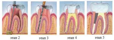 Видалення нерва зуба наслідки процедури