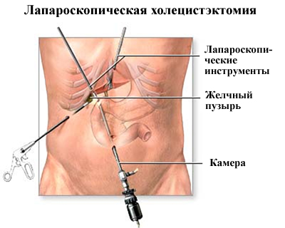 Видалення жовчного міхура (холецистектомія)