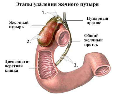 Epehólyag eltávolítása (cholecystectomia)