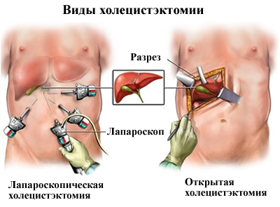 Видалення жовчного міхура (холецистектомія)