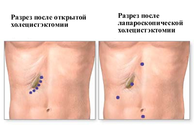 Видалення жовчного міхура (холецистектомія)