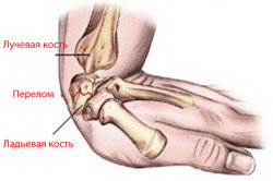 Exerciții pentru dezvoltarea unei mâini după fractură