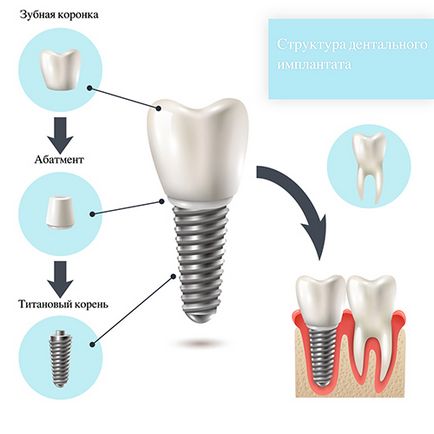 Implantarea unui dinte, costul chirurgiei, protocolul chirurgical