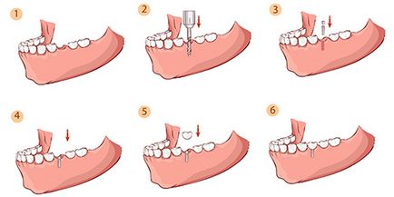 Implantarea unui dinte, costul chirurgiei, protocolul chirurgical