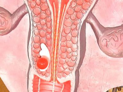 Varicozitatea uterului provoacă vene varicoase parametrul, simptomele și tratamentul