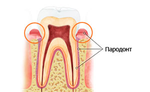 Види пародонтиту зуба
