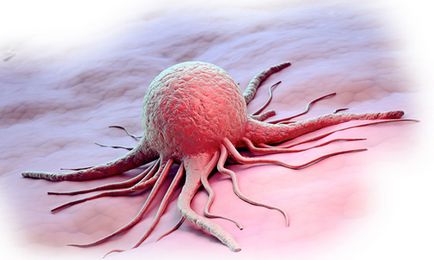 Tipuri de cancer 5 tipuri de tumori maligne (video)