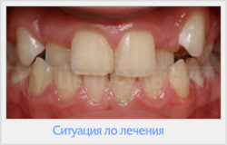Alinierea dinților