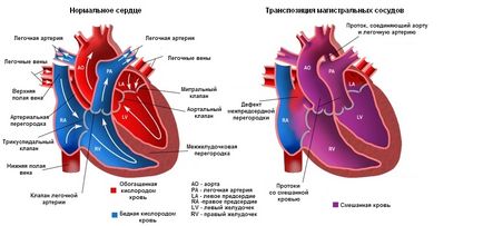 Характеристика та лікування транспозиції магістральних судин