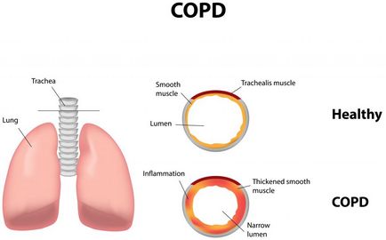 A krónikus obstruktív bronchitis felnőtteknél az etiológia, patogenezis, a tünetek