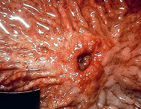 Ulcer de stomac