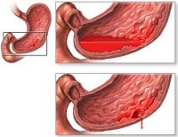 Ulcer de stomac