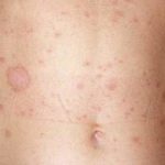 Zalain (gyertyák, tejszín) használati utasítások, ár, vélemények és analógok (alkalmazás) Zalain (gyertyák, tejszín) használati utasítások, ár, vélemények és analógok