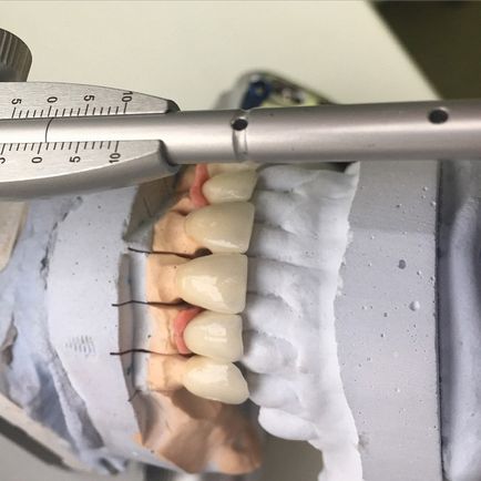 Típusú koronák, az ár, a telepítés Moszkvában, az előnyök és hátrányok - Dental max